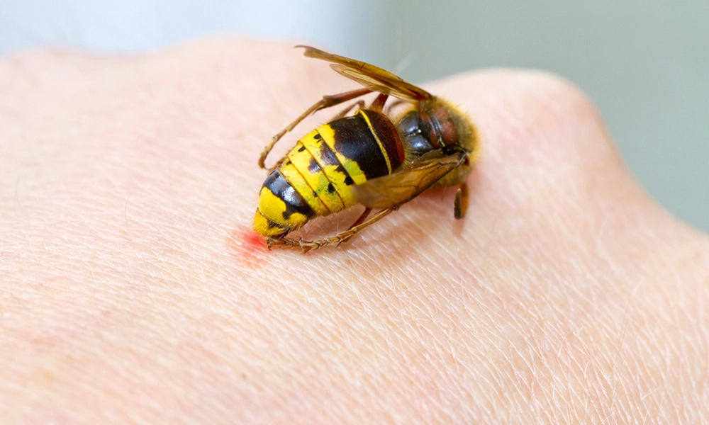 A close-up of a wasp stinging a person's skin, highlighting a common stinging pest found in Atlanta. The image emphasizes the need for pest control measures to prevent encounters with harmful stinging insects and reduce health risks.
